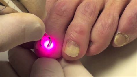 Nail fungus Laser therapy treatment - YouTube