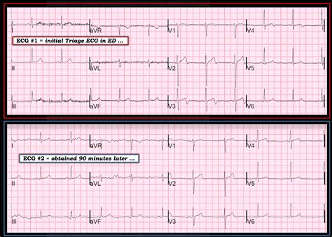 Dr. Smith's ECG Blog: Dynamic, Reversible, Ischemic T-wave inversion ...