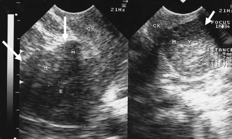 An intramural leiomyoma (large arrows) and a large cervical leiomyoma... | Download Scientific ...