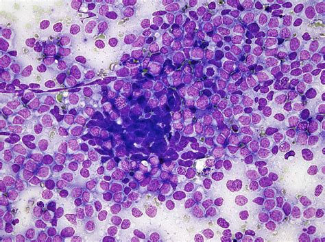 Pathology Outlines - Ewing sarcoma