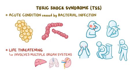 Toxic shock syndrome (TSS): Nursing - Osmosis Video Library