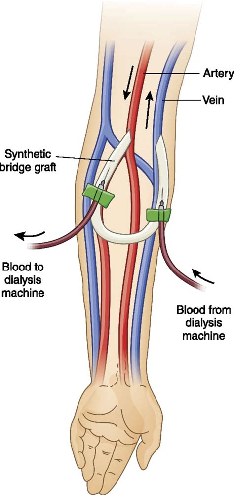 A Patient with Recurrent Arteriovenous Graft Thrombosis | American Society of Nephrology