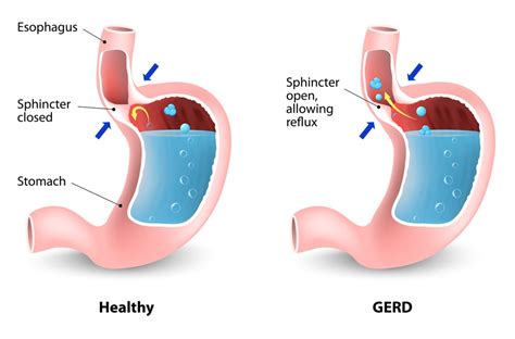 Gastroesophageal Reflux Disease Treatments | Gastro Health