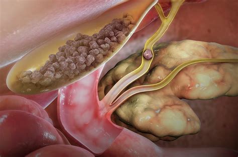 Gall And Bladder Stones Photograph by Scientificanimations.com / Science Photo Library - Pixels