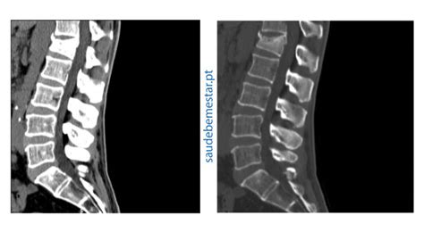 TC ou TAC da Coluna - Exames de Tomografia Computorizada
