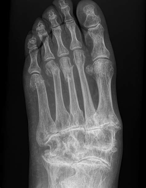 Foot Arthritis | Dr Ben Beamond | Adelaide