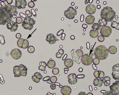 Calcium carbonate crystals | eClinpath