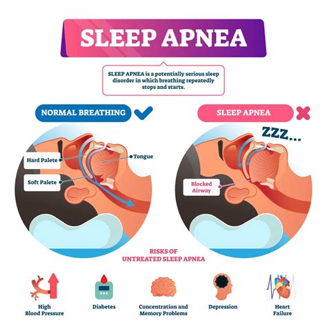 AWAKE: Sleep Apnea: CPAP therapy and strategies for peaceful sleep | Cayuga Medical Center