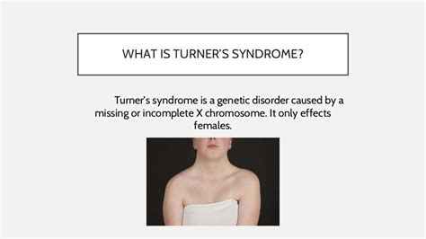 Turner syndrome