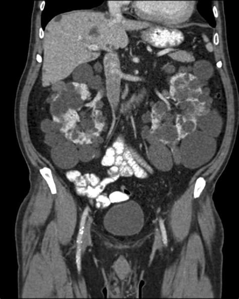 What Is the Contrast Dye Used in CT Scans? - HealthProAdvice