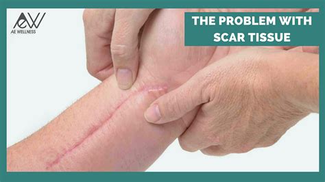 The Problem with Scar Tissue - AE Wellness