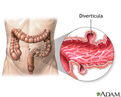 Diverticulitis Information | Mount Sinai - New York