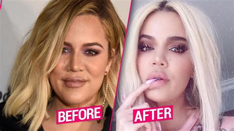 Khloe Kardashian’s Plastic Surgery Makeover After Split