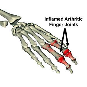 Hand Surgery For Arthritis Suffering Patients By Dr. Start Gold