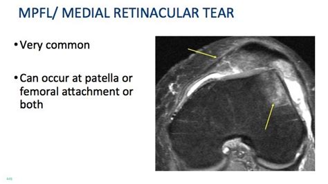 Knee MRI Patella Dislocation - Radedasia