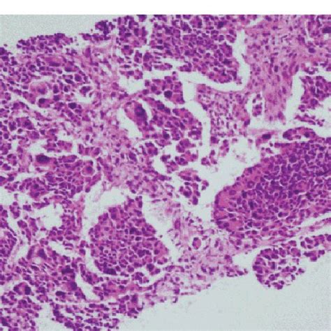 (PDF) Combined Large Cell Neuroendocrine Carcinoma of the Lung