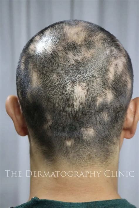 Alopecia Treatments For Men | The Dermatography Clinic