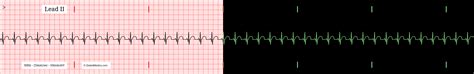 The Sinus Tachycardia EKG/ECG