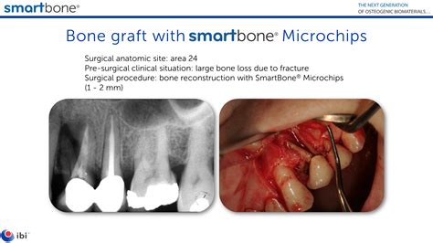 Reconstruction with SmartBone Microchips after bone loss due to ...