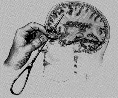 Lessons to be learnt from the history of lobotomy | Tidsskrift for Den ...