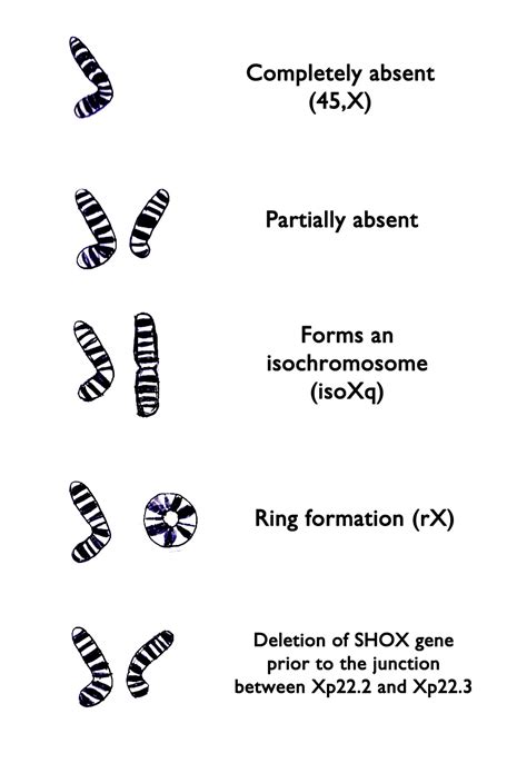 Chromosome Makeup Of Turner Syndrome | Makeupview.co