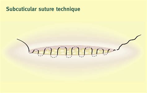 Skin incisions and wound closure - Surgery - Oxford International Edition