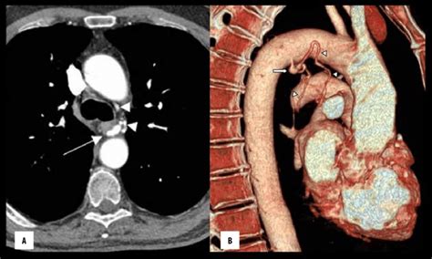 Pulmonary Artery Vs Bronchial Artery