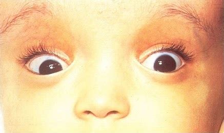 Medi Photos: Appearance of Sunset sign in infant eyes