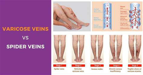 What is difference between spider veins and varicose veins? | Sri Ramakrishna Hospital