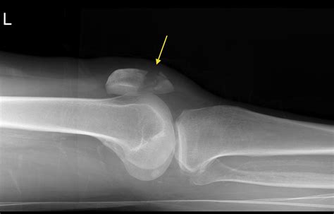 Patellar fracture - Radiology at St. Vincent's University Hospital