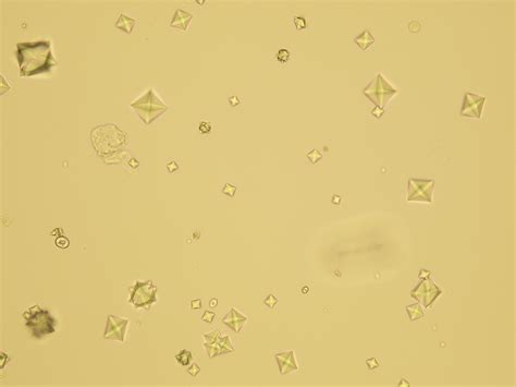 Calcium Oxalate Dihydrate Crystals In Urine