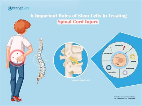 6 Important Roles of Stem Cells in Treating Spinal Cord Injury