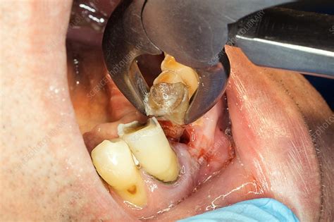 Decayed lower incisor extraction - Stock Image - C037/4491 - Science Photo Library