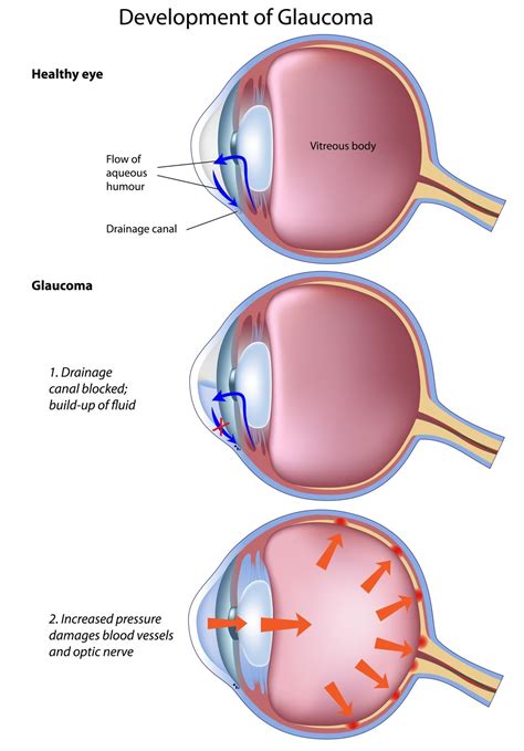 Sign and Symptoms of Glaucoma | Dr. Belgorod