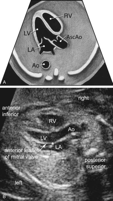 Fetal Lvot Ultrasound