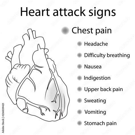 Heart attack signs, symptoms. Myocardial infarction. Damaged heart muscle. Medical, anatomical ...