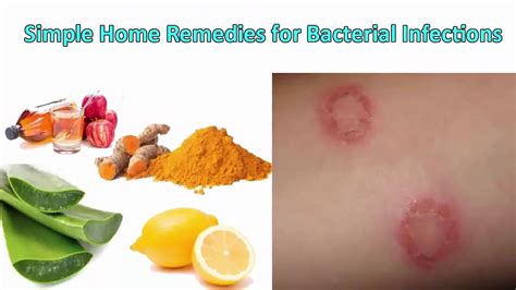 5 Homemade Remedies for Bacterial Infections By Homemade Remedies - YouTube