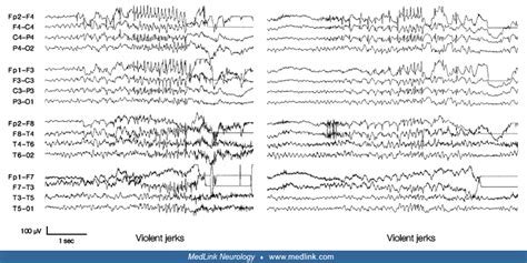 Myoclonic Seizures | MedLink Neurology