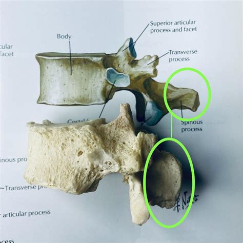 Netters T12 vertebrae vs real T12 vertebrae. You can see natural ...