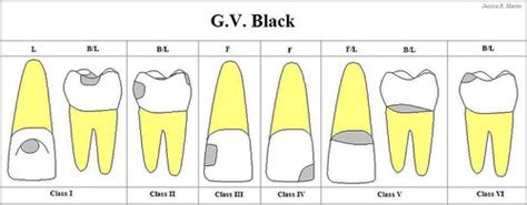 Black's Classification of Cavities Flashcards | Quizlet