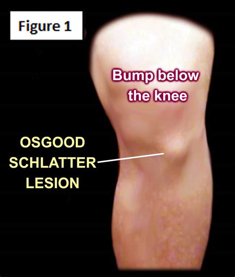 Osgood-Schlatter Disease | HuffPost Life