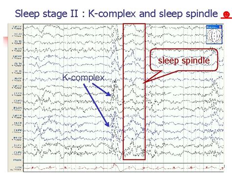 Talk n n n Definition of normalabnormal EEG