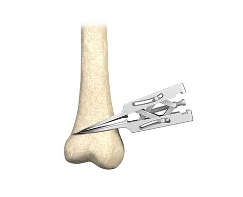 Distal Femoral Osteotomy System (DFOS) - OrthoPediatrics