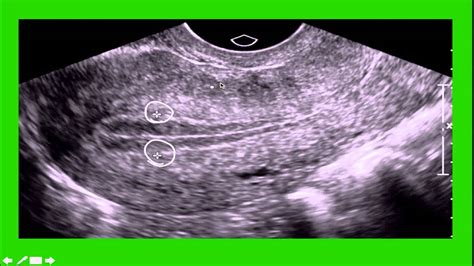 GYN Ultrasound - YouTube