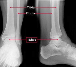 Talus Bone — Definition, Location, Anatomy, Diagrams