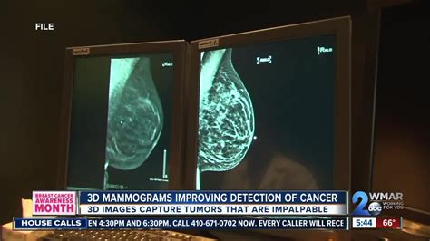 3D Mammograms used to detect breast cancer