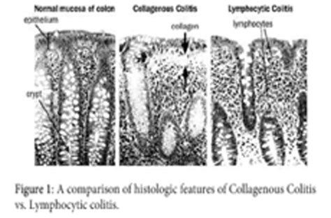 Lymphocytic Colitis