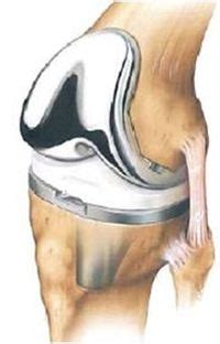 Total Knee Joint Replacement Revision Surgery - Physiopedia