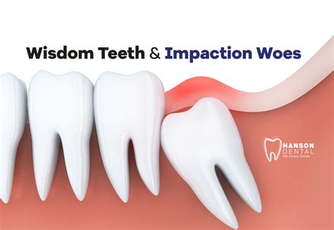 Wisdom Teeth & Impaction Woes - Hanson Dental - Dentist in Buffalo MN