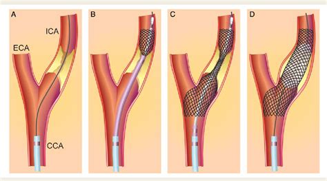 Figure 3 from Carotid artery stenting vs. endarterectomy. | Semantic ...